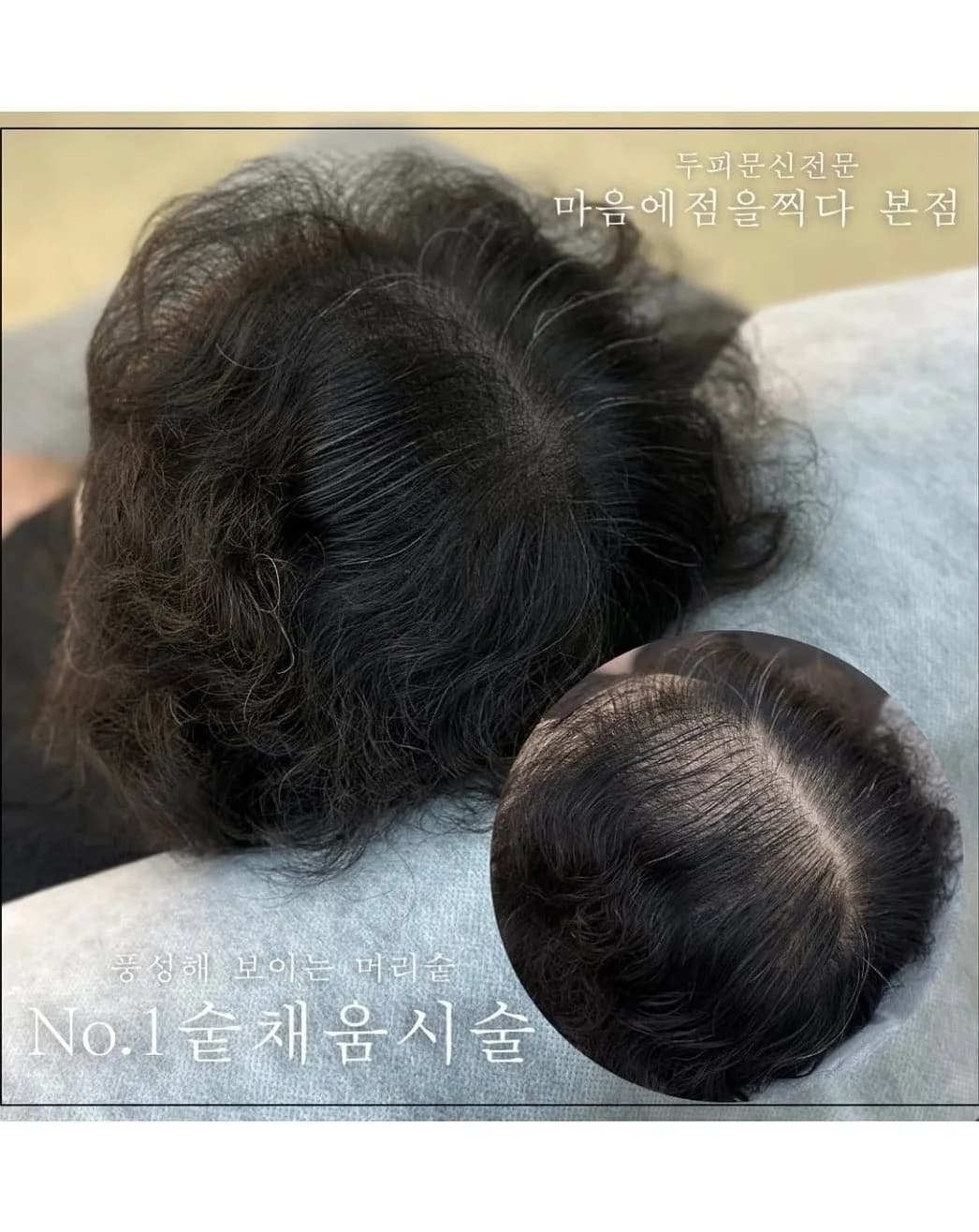 숱이 비어 보이던 부분을 채운 시술 후 모습