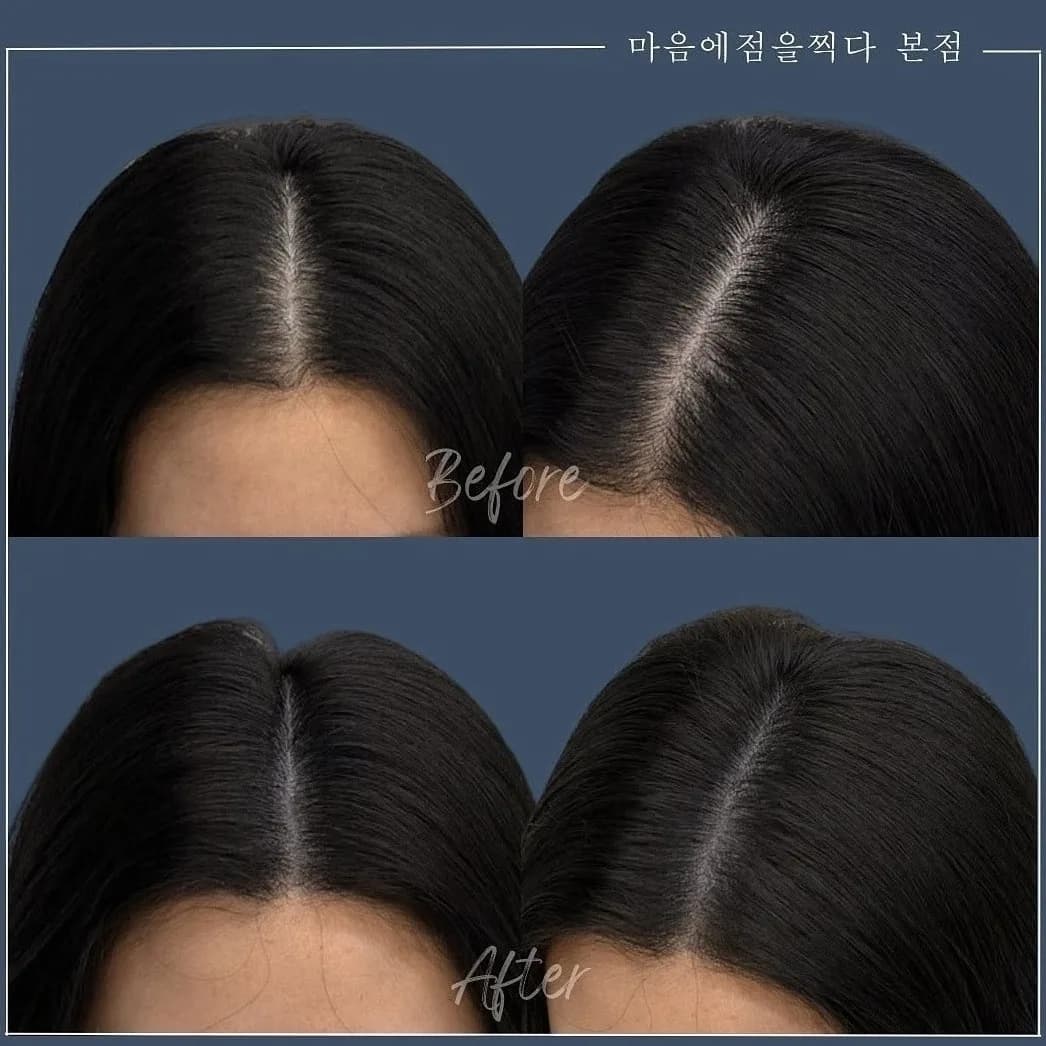 가르마 부위를 여러 각도에서 본 시술 전과 후