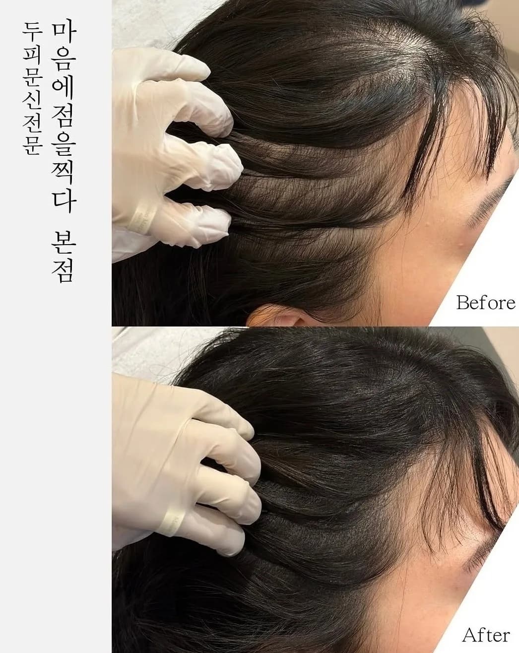 손으로 가르마를 벌려 확인한 시술 전과 후