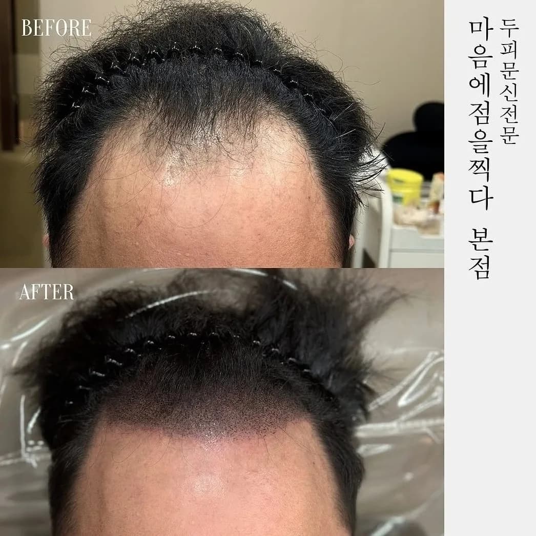 앞머리 헤어라인을 다시 잡은 시술 전과 후