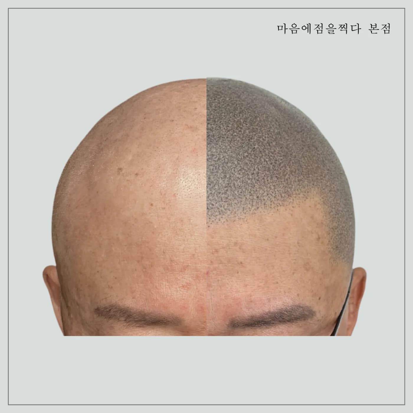 민머리 두피문신을 절반만 시술해 좌우를 비교한 모습