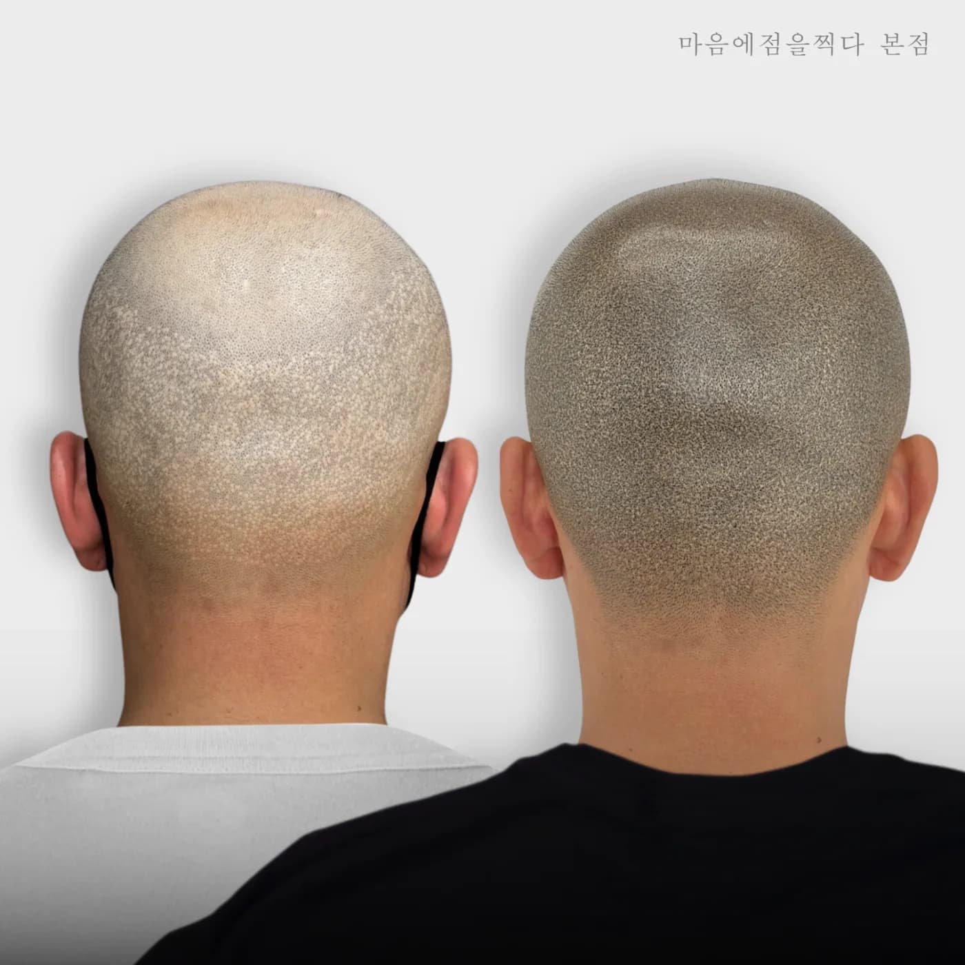 뒷머리 민머리 시술 전과 후