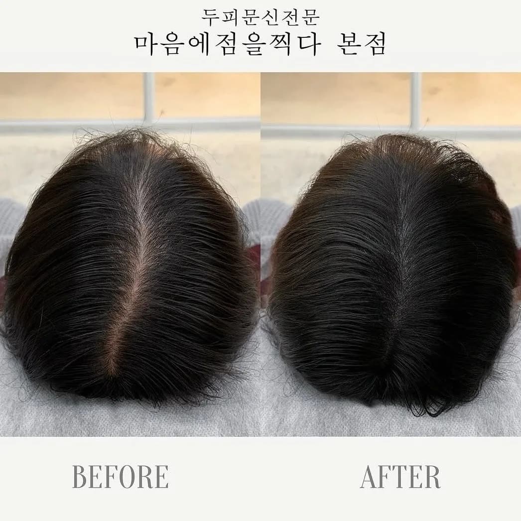 정수리 두피문신 시술 전과 후를 위에서 본 모습