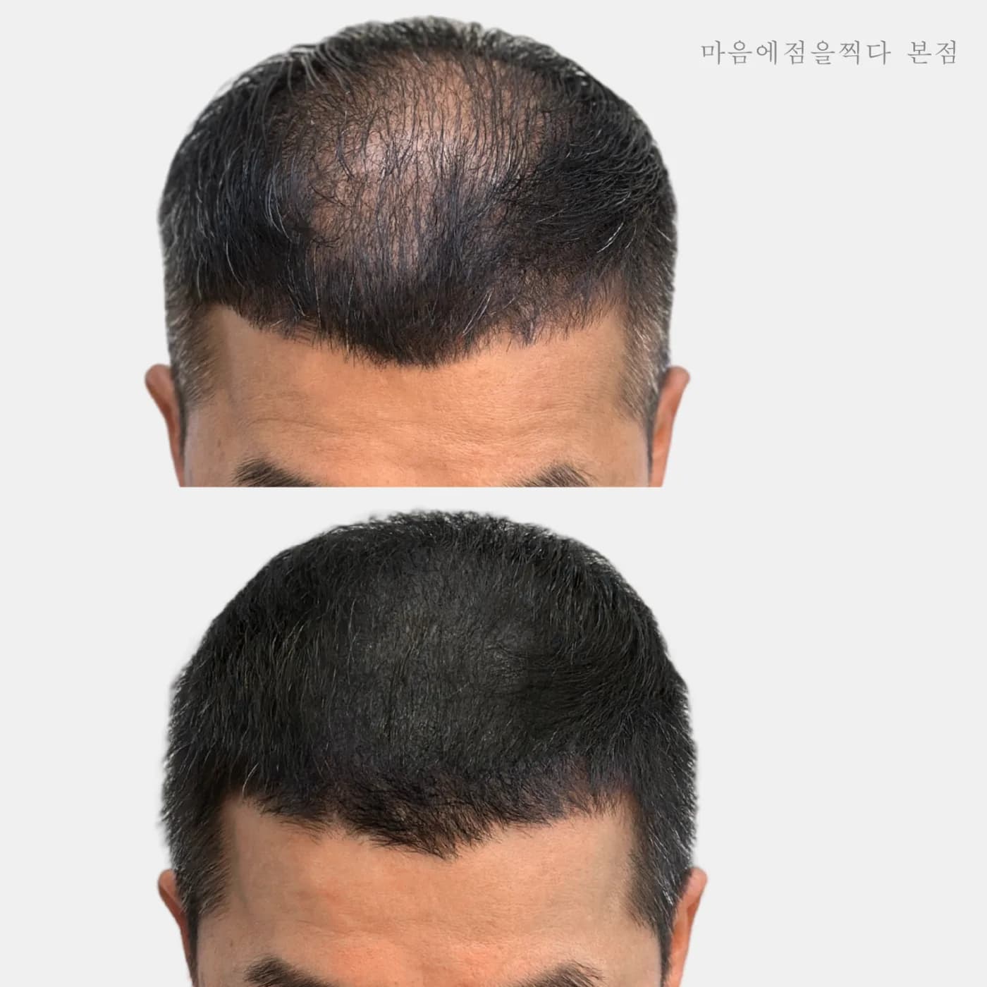 남성 정수리 두피문신 시술 전과 후
