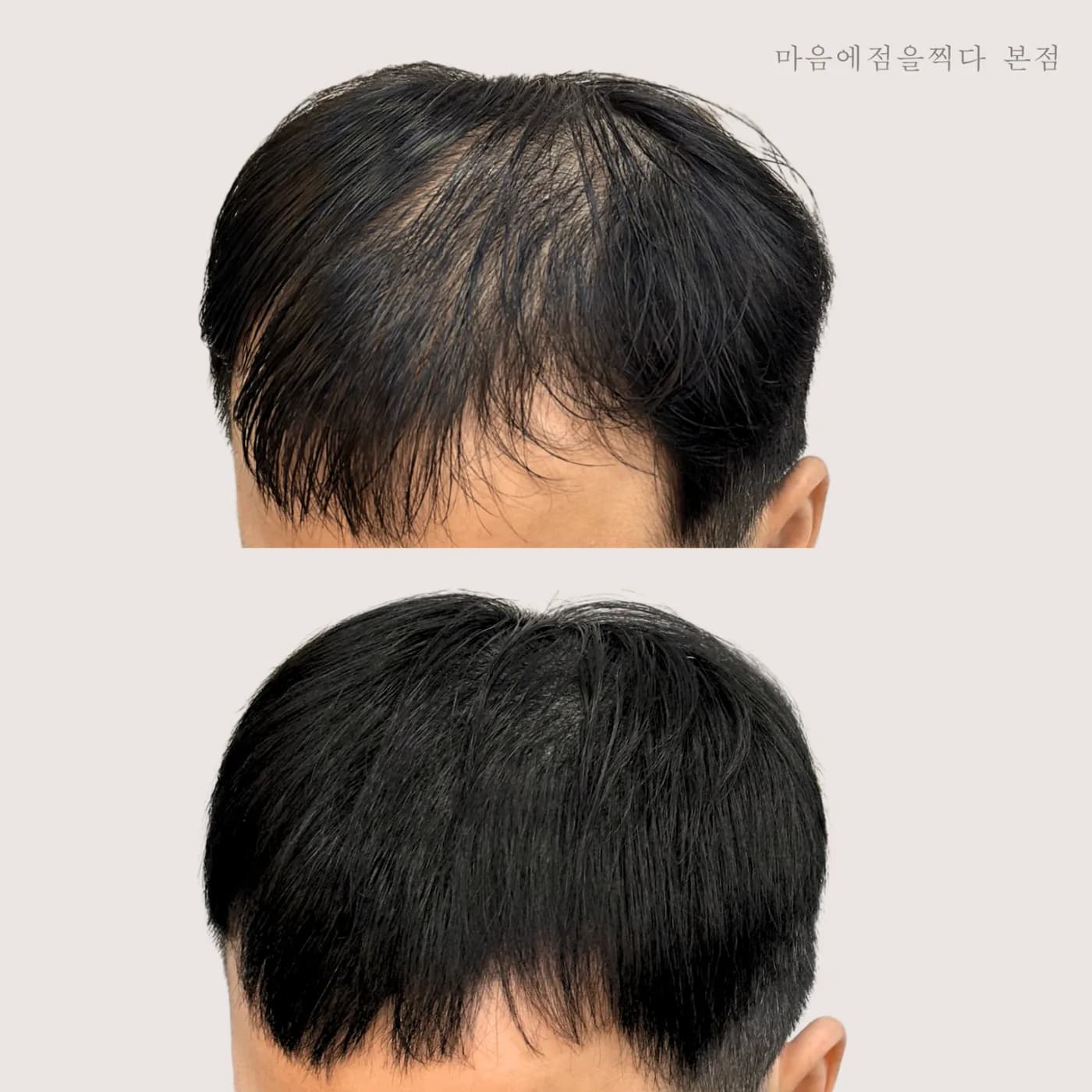정수리 숱이 비쳐 보이던 부분을 채운 시술 전후