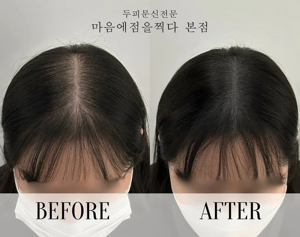 여성 앞머리 헤어라인 시술 전과 후