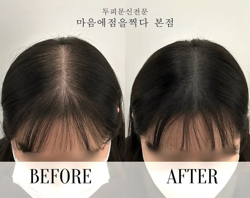 헤어라인 앞쪽 잔머리 부분의 시술 전과 후
