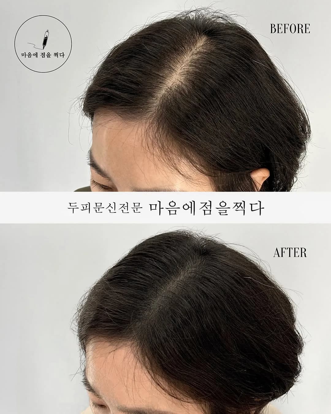 옆에서 본 헤어라인 시술 전과 후