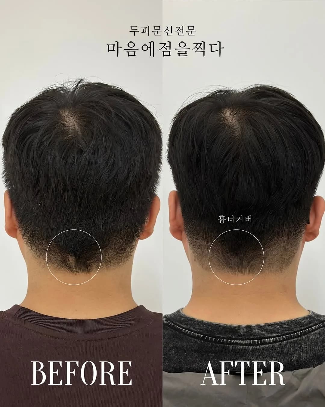 뒷머리 흉터 부위를 표시한 시술 전과 후