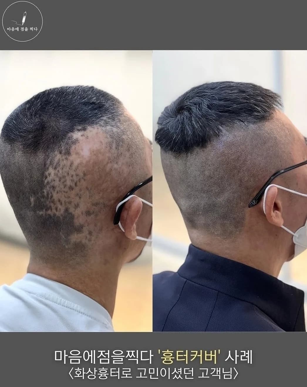 화상 흉터를 덮은 두피문신 시술 전과 후