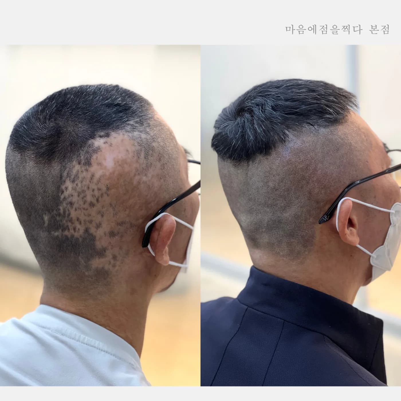 측면 흉터 부위 시술 전과 후