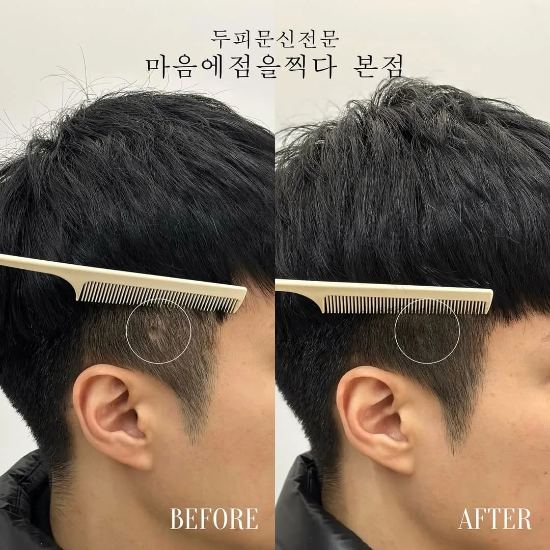 M자 이마 양쪽 들어간 부분의 시술 전과 후