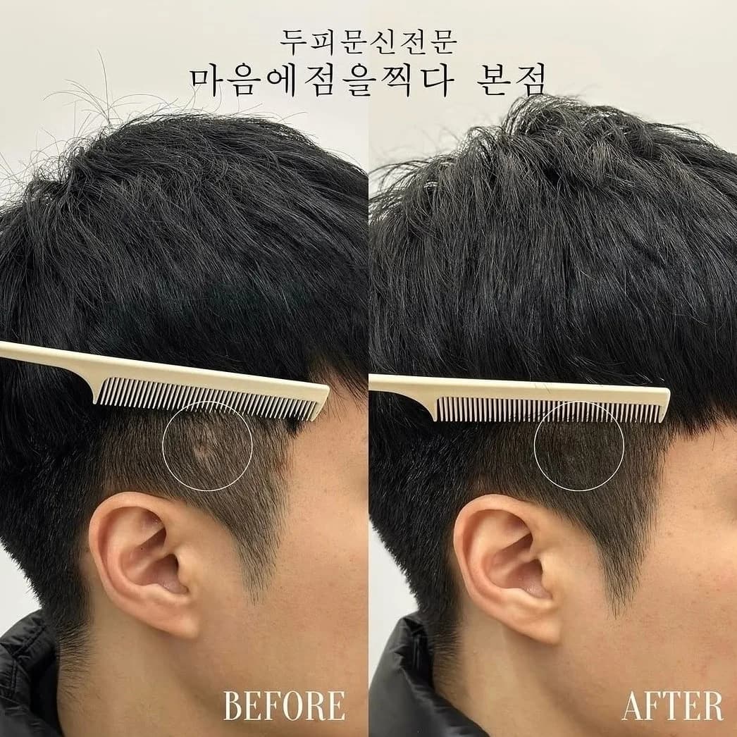 빗으로 가르며 확인한 M자 부위 시술 전과 후