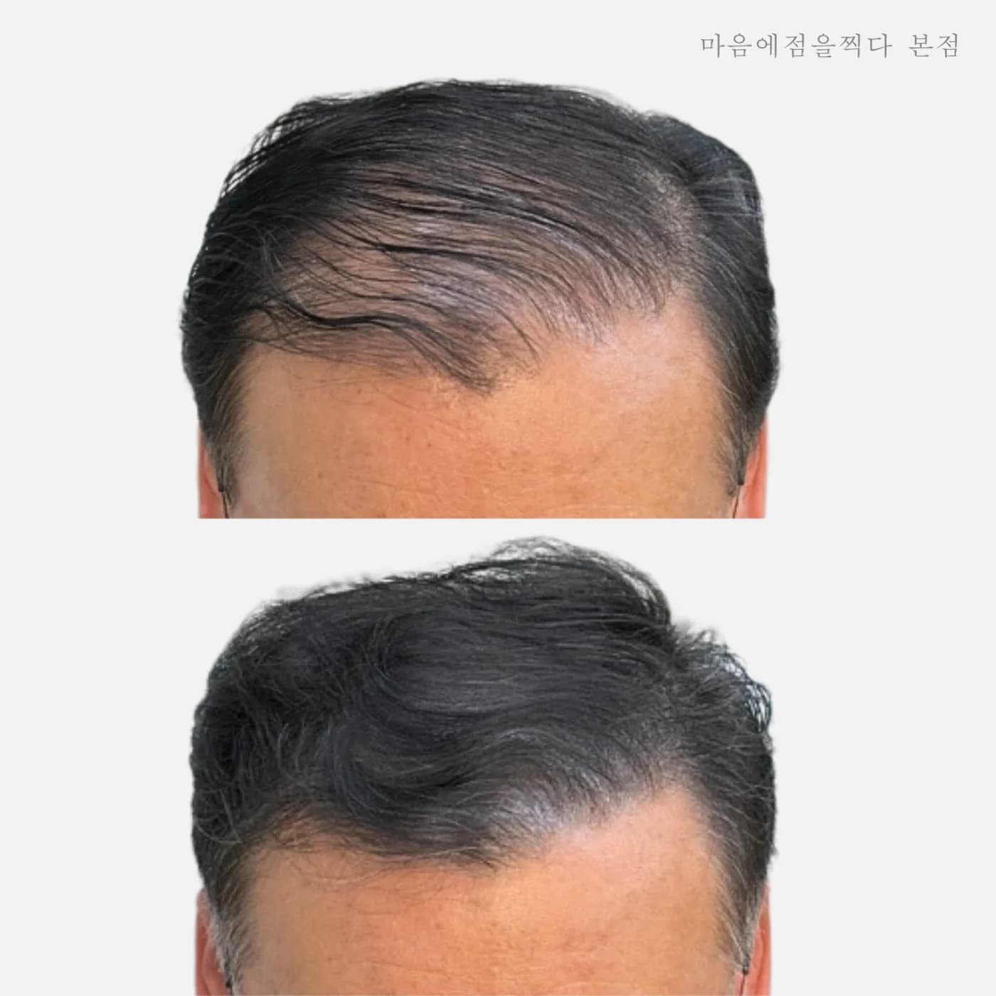 남성 앞머리 M자 부위 시술 전과 후
