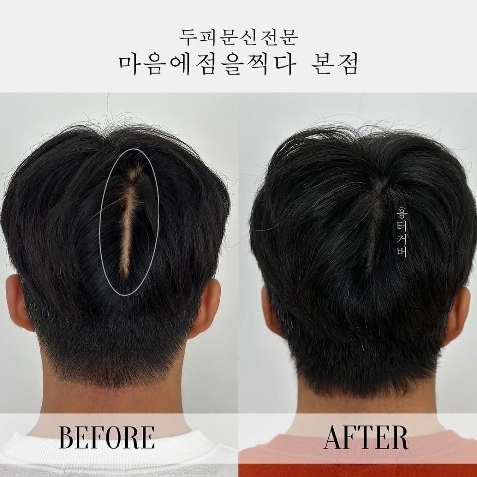 광주 두피 문신 흉터 커버 와 비어있는 두피 후기