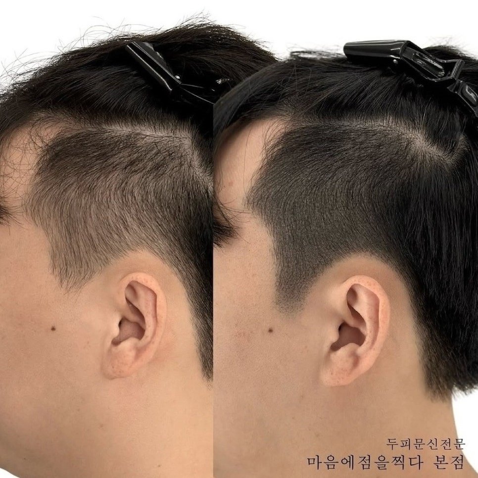 광주 남자 남성 헤어라인 SMP 두피 문신 탈모 고민될 때