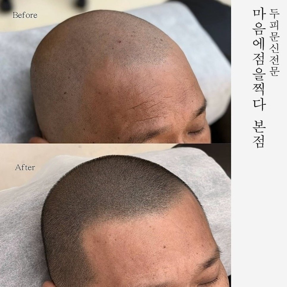 광주 smp 두피문신 탈모 흉터 문신 과 헤어라인 커버