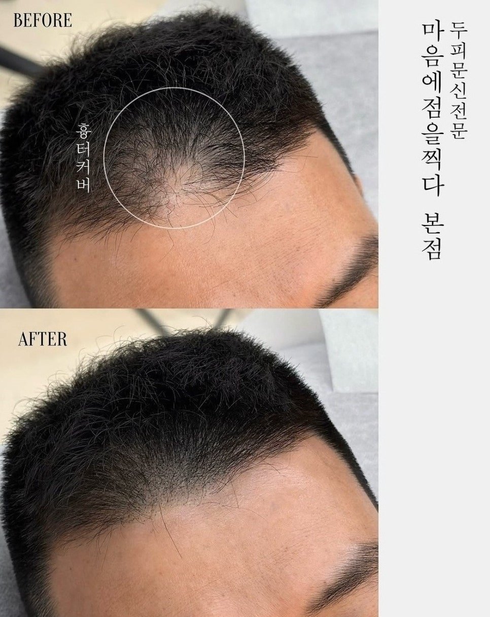 광주 SMP 두피 문신 가르마 자연스러운 기준